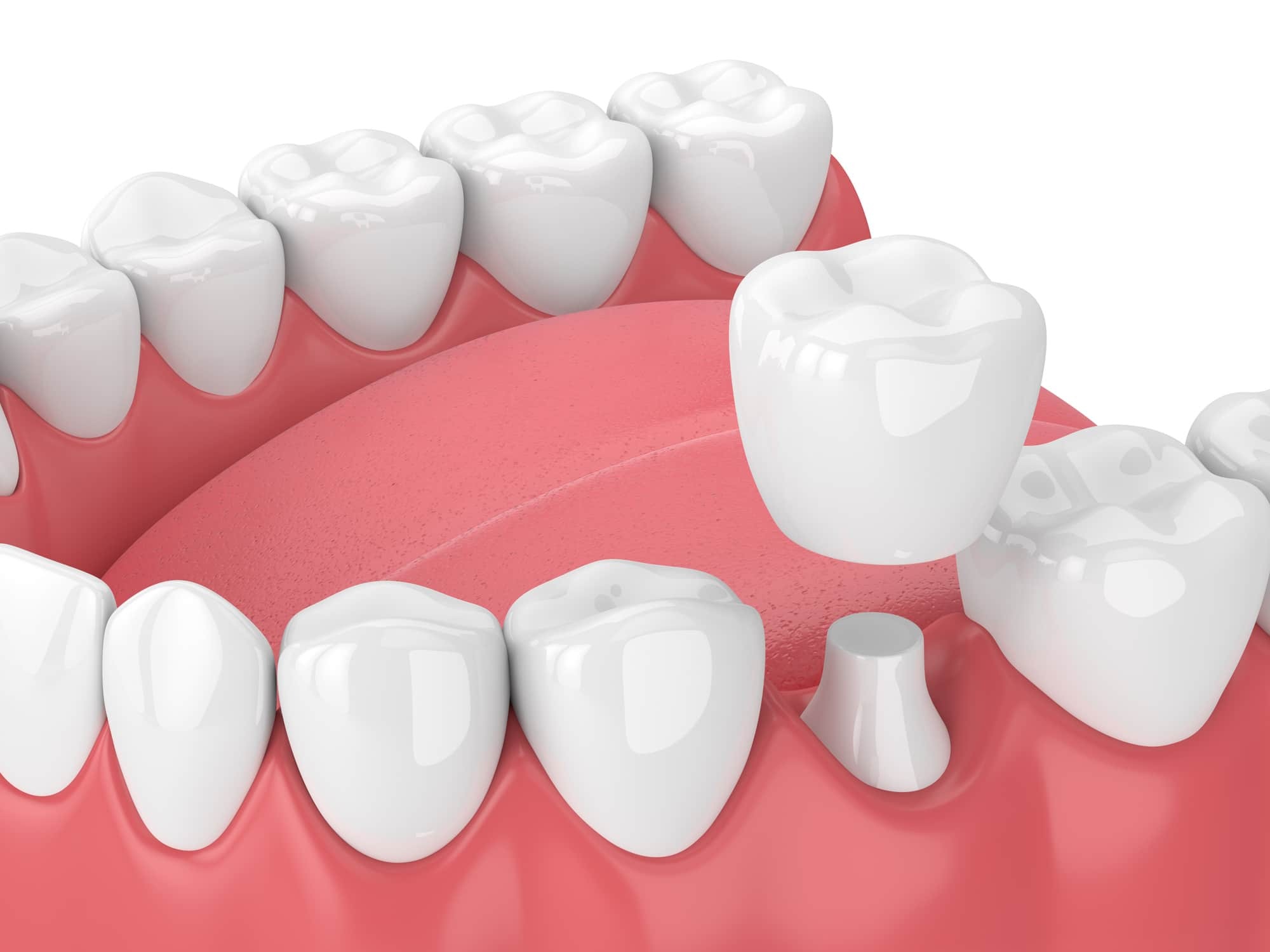 3D illustration of a dental crown restoration on a patient's tooth in Paradise Valley, AZ.