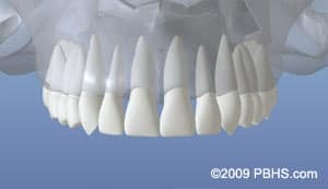 Digital model of a full dental implant arch for Paradise Valley, AZ patients.