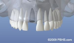 Dental implant restorations showing full arch replacement teeth positioned in upper and lower jaw alignment.
