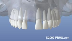 Dental implant crowns displayed showing natural tooth-colored restorations for smile reconstruction.