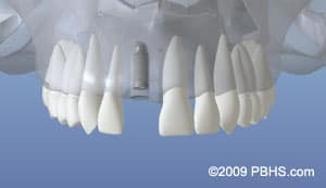 Digital model of dental implants showing full upper and lower tooth replacement for Paradise Valley patients.