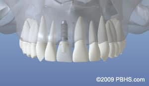 Dental implant crowns displayed in a full arch arrangement showing tooth restoration options.