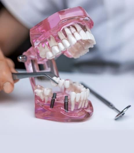 Dental implant demonstration model showing tooth replacement procedure with surgical instruments in Paradise Valley.
