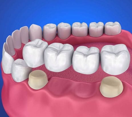 Dental bridge illustration showing missing teeth replacement with ceramic crowns on Paradise Valley teeth.