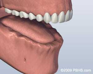Lower jaw with all teeth missing showing anatomy before ball attachment denture placement.