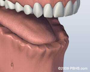 Lower jaw missing all teeth with bar attachment denture model showing dental implant restoration.