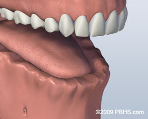 3D dental model showing lower jaw with all teeth missing, prepared for screw attachment denture restoration.