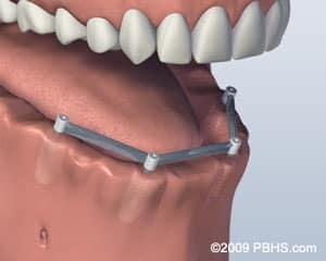 Lower jaw model showing four dental implants with bar attachment for implant-supported denture.