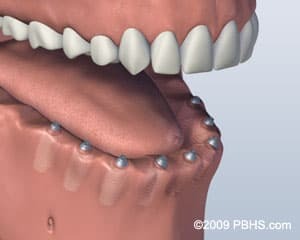 Lower jaw dental implant model showing six implants for screw-retained denture attachment.