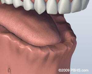 3D dental illustration showing lower jaw bone structure with missing teeth and upper dental prosthesis.
