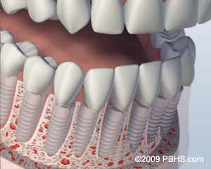 Dental implant diagram showing tooth root structure and bone integration in jaw.