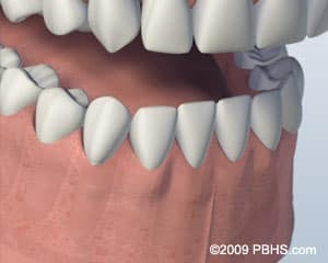 3D illustration of missing lower teeth showing dental implant placement in Paradise Valley, AZ.