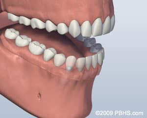 Implant-supported denture with ball attachments securing lower prosthesis to jaw implants.