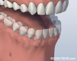 Bar attachment denture secured to lower jaw with four dental implants in Paradise Valley.