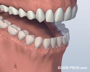 3D dental model showing screw-retained implant denture secured to lower jaw with six implants.