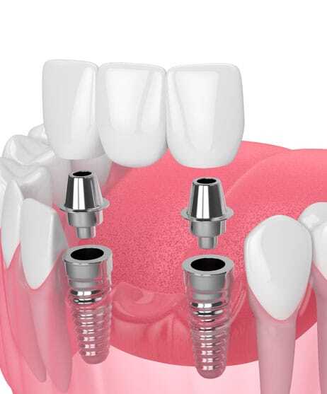 Implant-supported overdentures with dental implants and abutments on pink gum model.