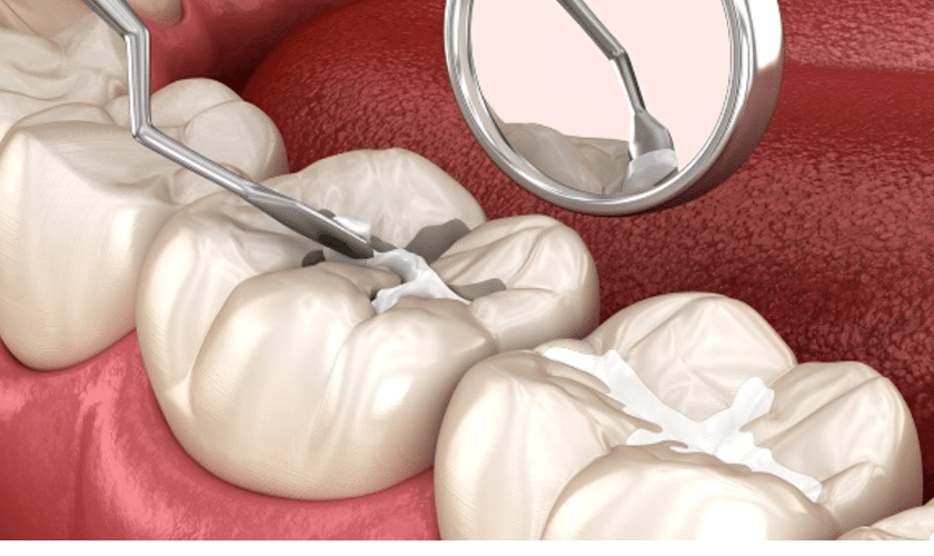 Dental sealant application on back teeth to prevent cavities and decay.