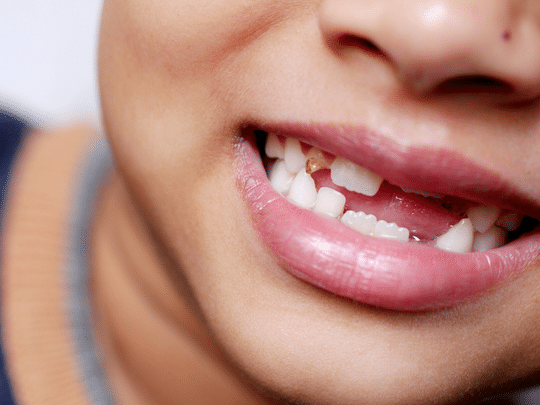 Close-up of a child's smile showing healthy white teeth and pink gums.