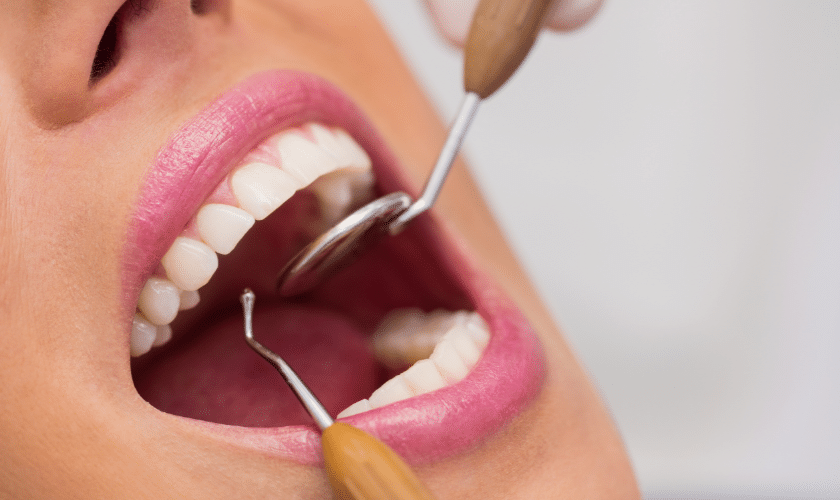 Close-up of dental sealant application to patient's tooth using professional instruments.