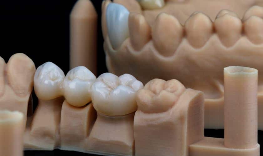 Dental crown models displaying tooth-colored restorations on a practice display model.
