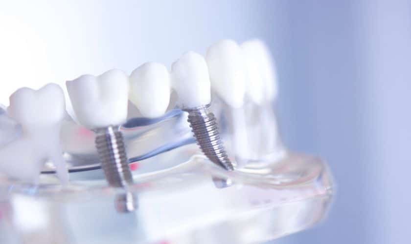 Dental implant model showing multiple tooth replacements with titanium screws on transparent base.