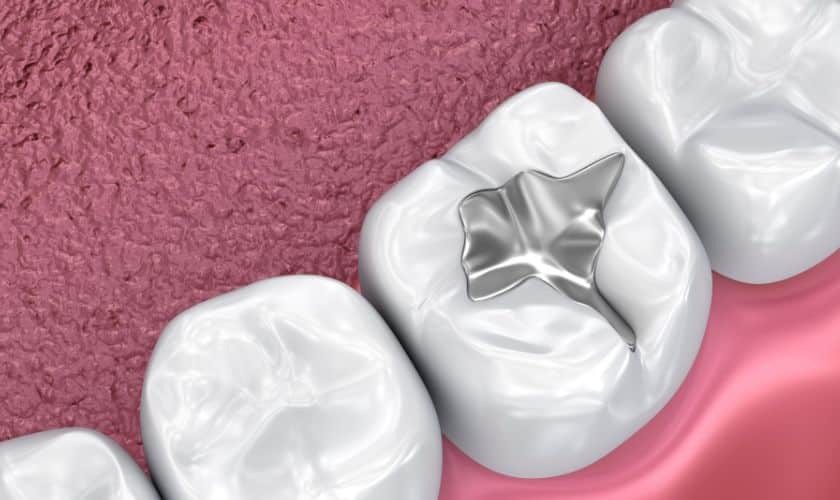 Dental sealant illustration showing tooth surface protection against decay on molar.