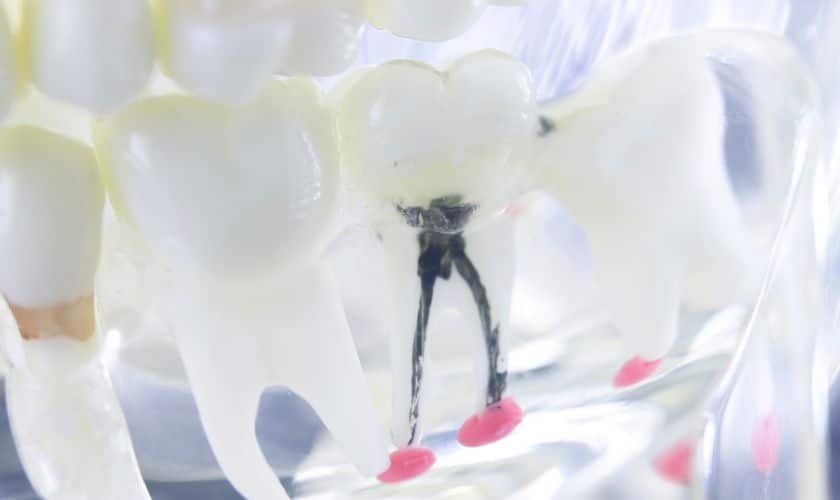 Close-up of a dental instrument extracting debris from a tooth during root canal treatment.