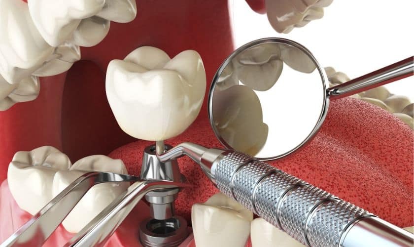 Dental implant tools and tooth models displayed on red surface for overdenture consultation.