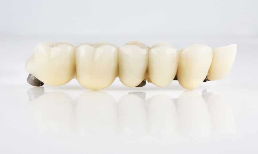 Dental bridge prosthetic showing six tooth-colored crowns with metal connectors for tooth replacement.
