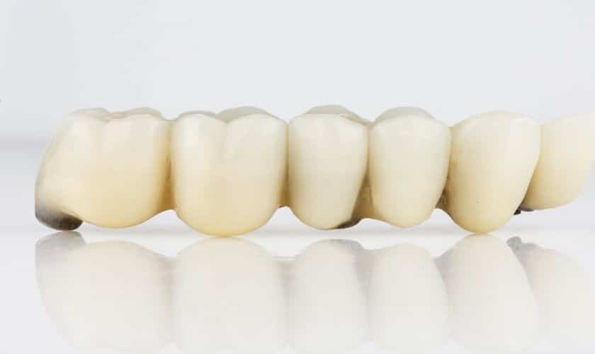 Dental bridge restoration showing six tooth-colored crowns joined together for missing teeth replacement.