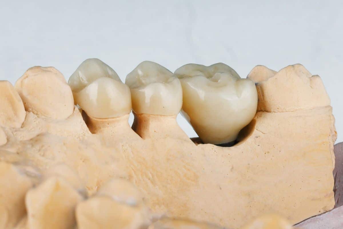 Featured image for “The Impact of Dental Crowns on Bite Alignment”