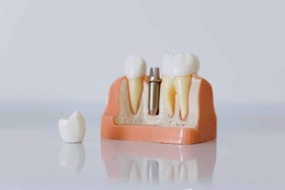 Dental implant model showing titanium screw placement in jawbone with crown restoration.
