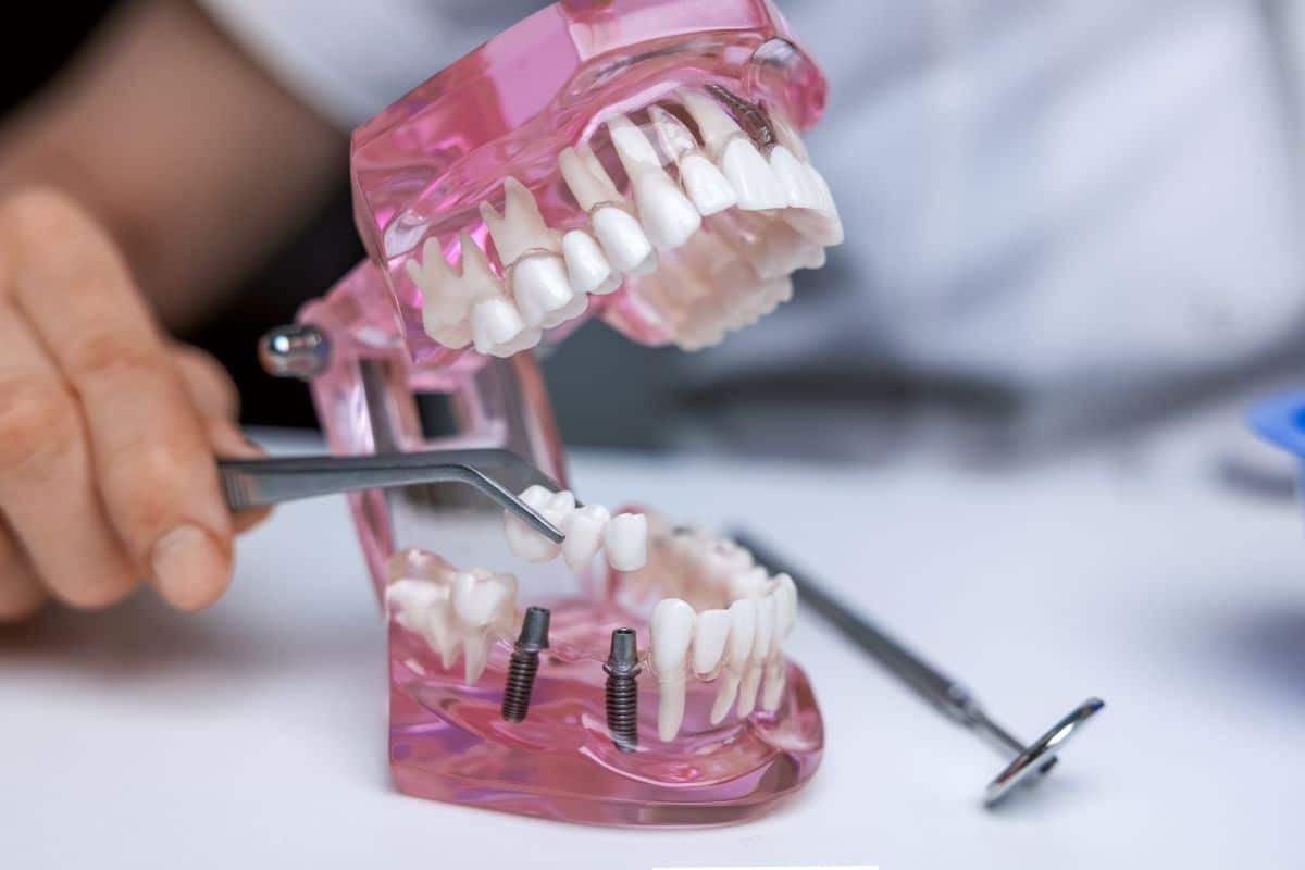 Dental implant model showing tooth replacement with titanium implants and prosthetic teeth.