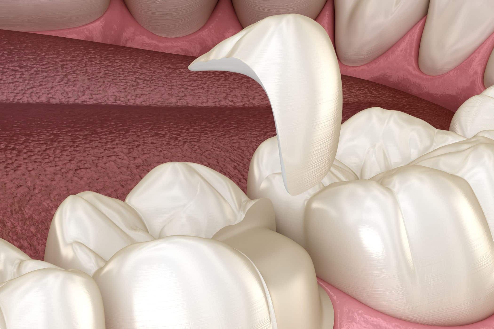 3D dental illustration showing inlay and onlay restorations on posterior teeth in Paradise Valley.