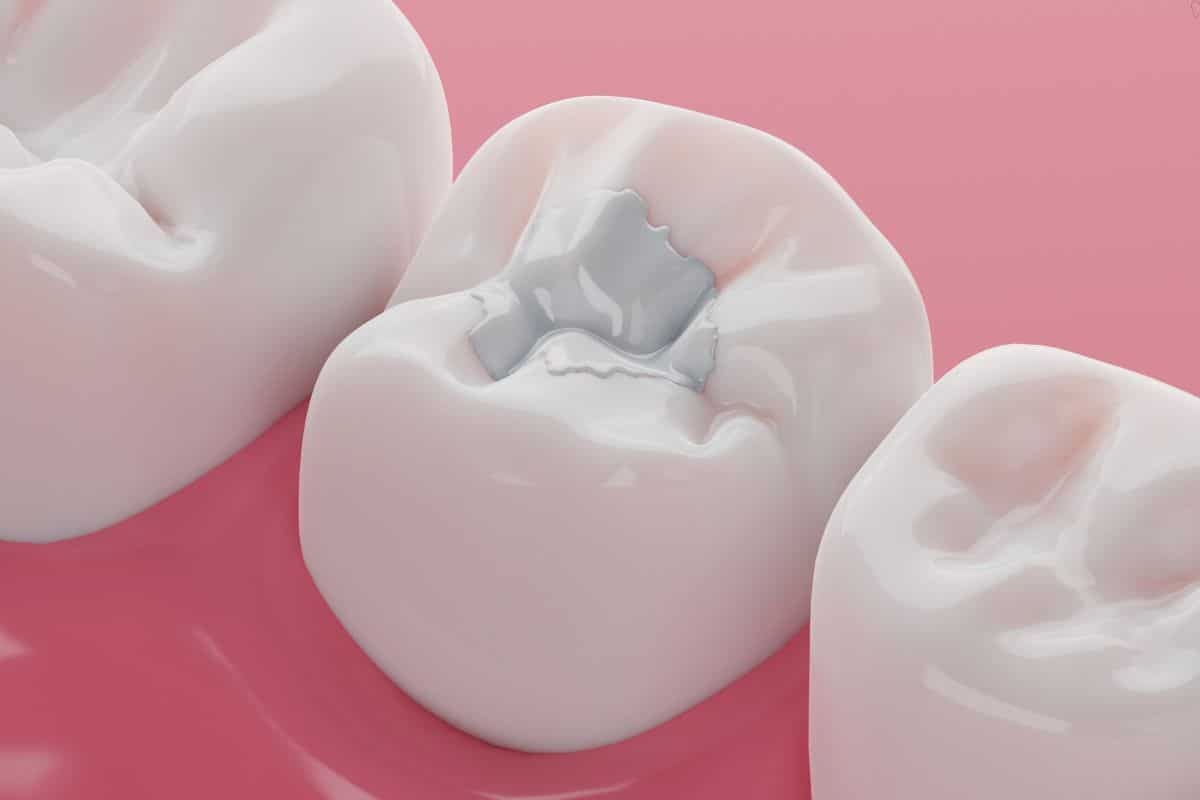 3D illustration of a tooth with dental filling material showing cavity treatment.