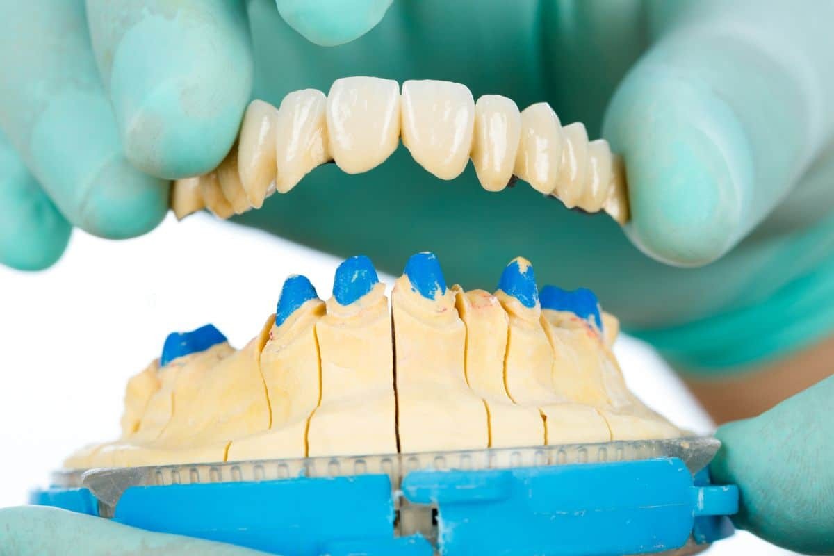 Dental bridge model showing how tooth replacement prevents adjacent teeth from shifting after tooth loss.