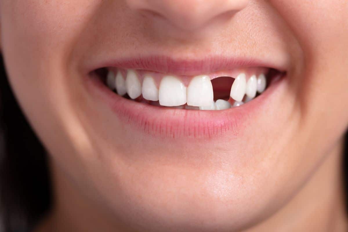 Close-up of a smile showing missing upper front teeth with a dark gap, illustrating tooth loss impact.