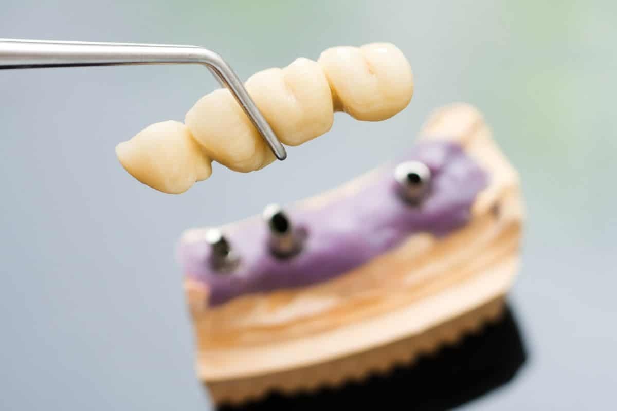 Dental bridge restoration showing porcelain tooth units held with dental instrument above implant model.