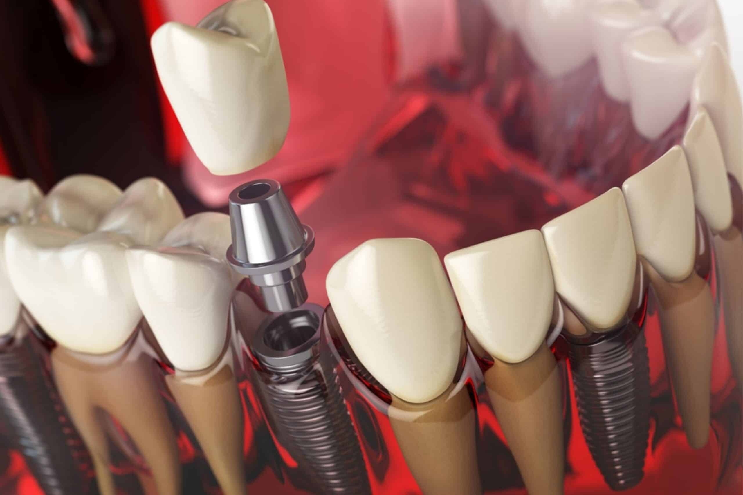 Featured image for “How Long Does the Entire Dental Implant Process Take?”