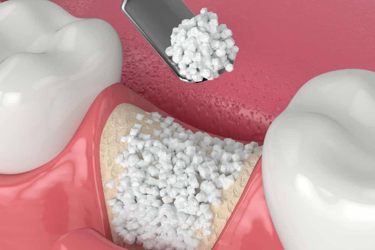 Bone grafting materials displayed on dental model showing graft particles and surgical instrument for implant site preparati.