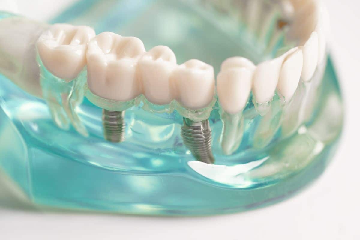 Dental implant model showing crown restorations on transparent jaw model in Paradise Valley, AZ.