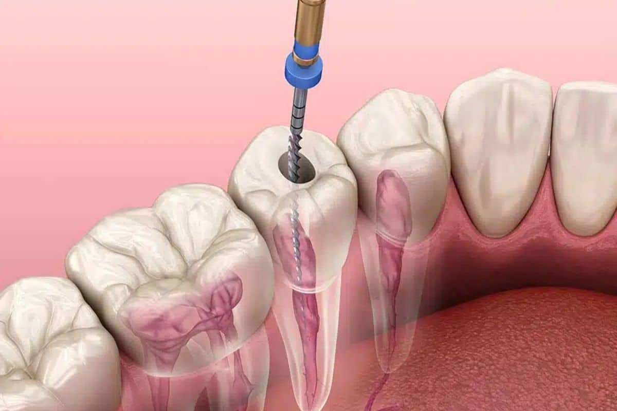 Root canal treatment procedure showing drill accessing tooth interior through crown.