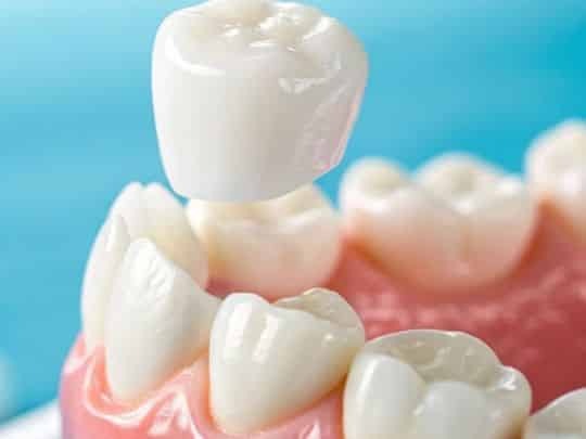 Dental crown restoration model showing tooth preparation and ceramic crown placement on implant.