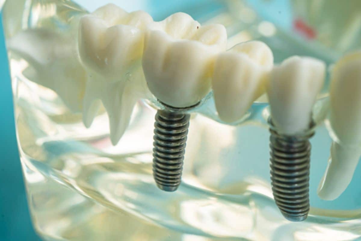 Dental implant model showing two titanium implant screws with ceramic crowns demonstrating successful implant placement.