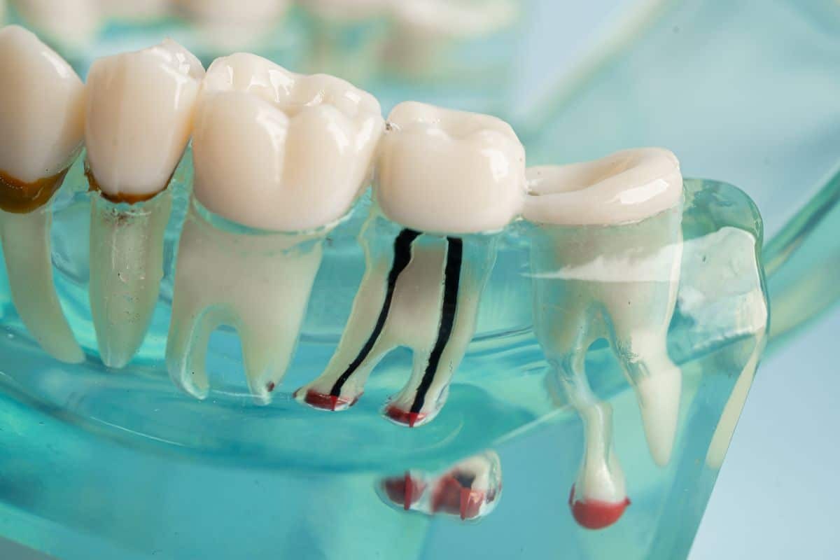 Dental model showing cross-section of teeth with nerve canal anatomy for root canal treatment education.