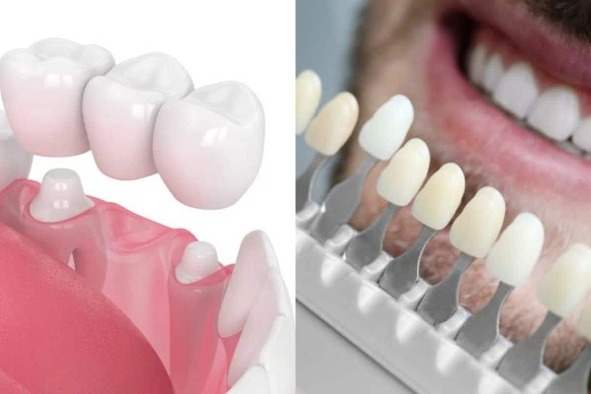 Dental crown and veneer comparison showing tooth restoration options in Paradise Valley.