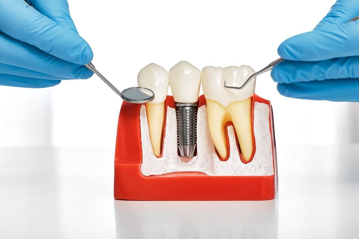 Dental implant model showing tooth replacement with crown and screw fixture between natural teeth.
