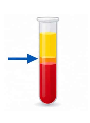Test tube showing separated blood layers with platelet rich plasma concentration.