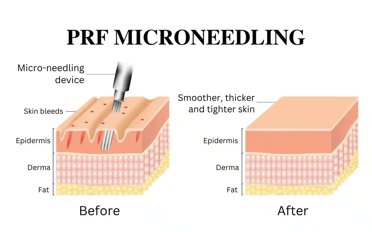 PRF for Facial Aesthetics