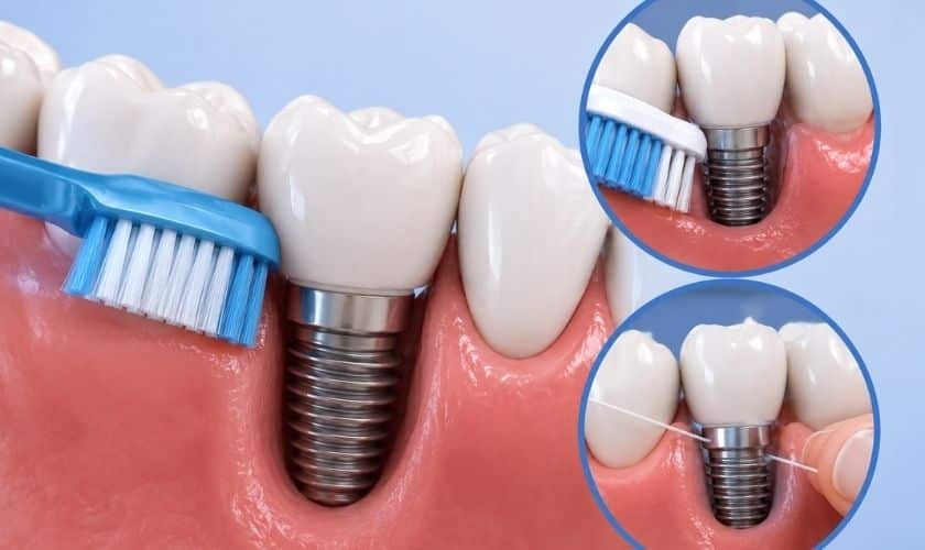 Featured image for “Brush and Floss Around Dental Implants”
